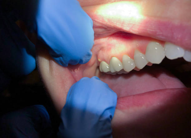 Best Emergency Dentist for Lost Fillings or Crowns in Glendale, CA